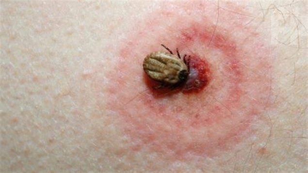 В Запорожье зафиксирован случай трудно излечимой болезни Фото № 1 В Запорожье зафиксирован случай трудно излечимой болезни Фото № 1