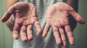 Опасный вирус не отступает, жители Запорожья продолжают болеть Фото № 0 Опасный вирус не отступает, жители Запорожья продолжают болеть Фото № 0