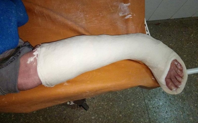 Общественница обвиняет мэра Буряка в том, что она сломала ногу Фото № 1 Общественница обвиняет мэра Буряка в том, что она сломала ногу Фото № 1
