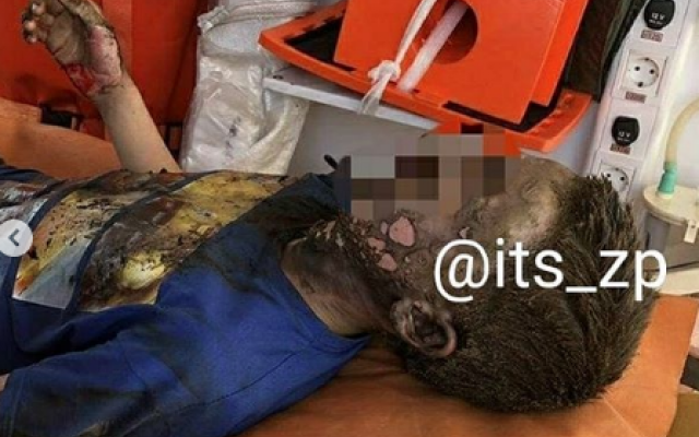 Чудом остался жив: Запорожский подросток пропустил через себя 10 тысяч вольт (ФОТО) Фото № 1 Чудом остался жив: Запорожский подросток пропустил через себя 10 тысяч вольт (ФОТО) Фото № 1