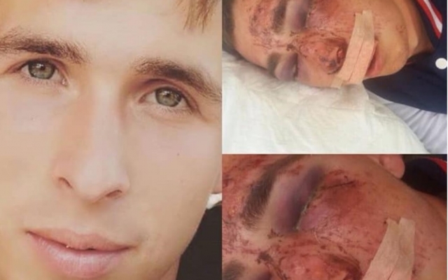 Под Запорожьем молодой парень попал в яму по недосмотру коммунальщиков и разбил череп и лицо (ФОТО 18+) Фото № 0 Под Запорожьем молодой парень попал в яму по недосмотру коммунальщиков и разбил череп и лицо (ФОТО 18+) Фото № 0