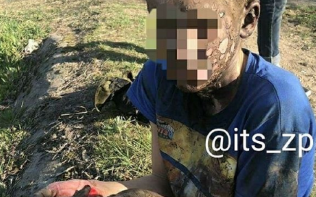 Чудом остался жив: Запорожский подросток пропустил через себя 10 тысяч вольт (ФОТО) Фото № 2 Чудом остался жив: Запорожский подросток пропустил через себя 10 тысяч вольт (ФОТО) Фото № 2