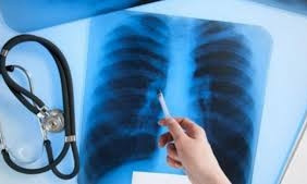 Запорожская область первая в Украине по заболеваемости туберкулезом среди детей